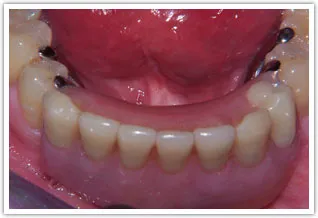 After dental implants-clip bar and a partial dentures