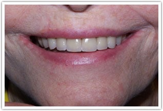 After photo of age appropriate porcelain veneers