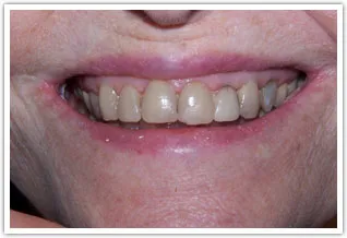 Before image of severely worn and discolored teeth