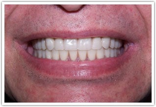 After dental implants with removable full dentures