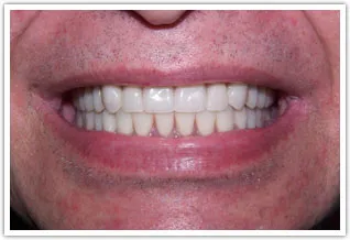 After dental implants with removable full dentures