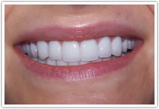 After ceramic crowns procedure at Markowitz Dental of Washington DC