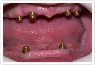 Before image of a patient missing all teeth