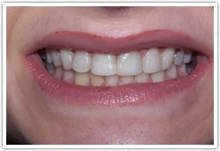 Before image of worn and dark teeth