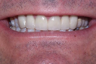 chipped-discolored-after