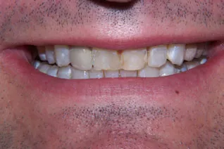 chipped-discolored-before