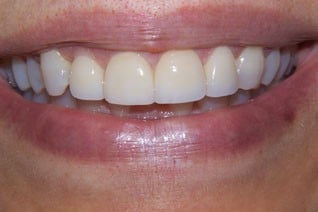 After prosthodontic treatment
