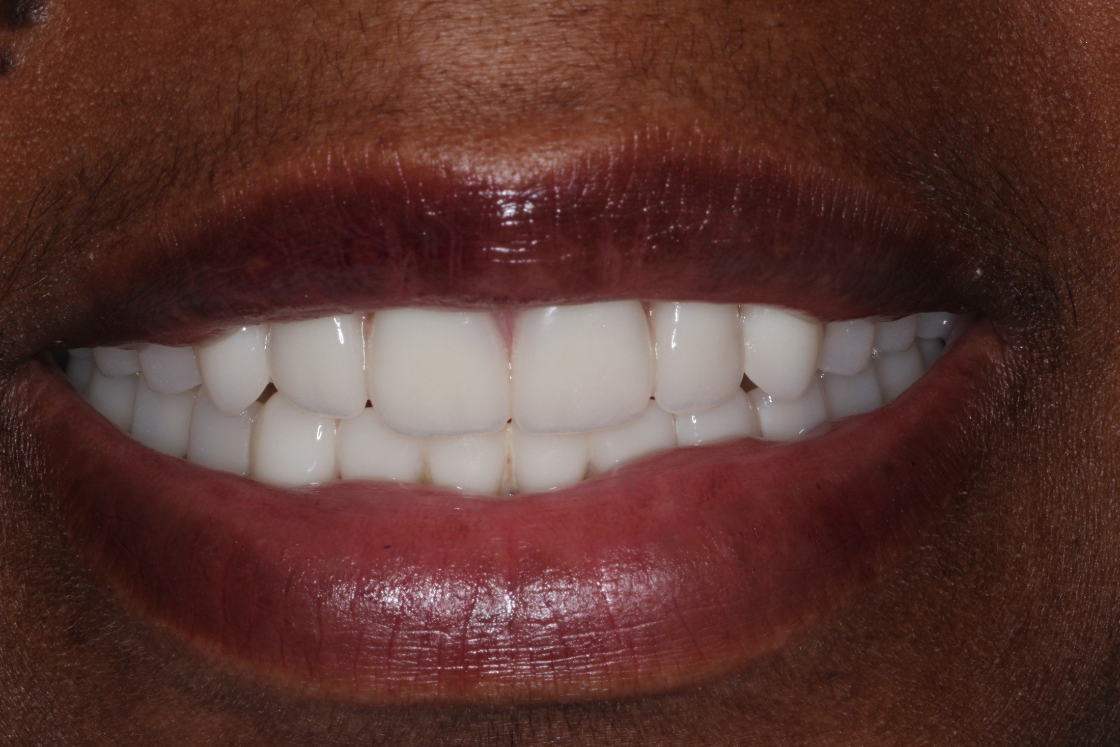 dentures-before-2