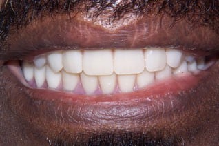 After denture