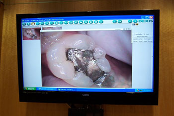 computer intraoral camera