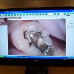 computer intraoral camera