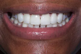 Porcelain veneers