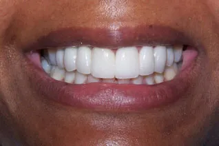 After prosthodontic treatment