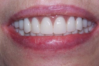 After Prosthodontic treatment