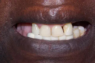 Missing teeth, ppor smile esthetics