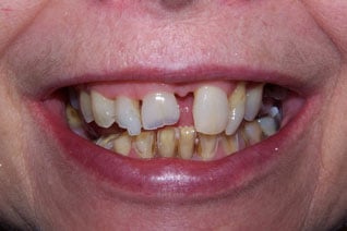 Before Prosthodontic treatment