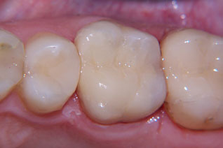 Tooth colored ceramic onlay