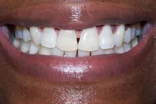 Crooked teeth