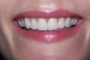 uneven gumline after