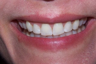 uneven gumline before