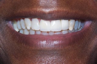 Dental implant, three crowns