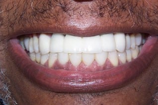 Dental bridge after restoration