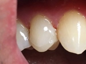 CEREC allows for consolidated planning, manufacturing, & restoration