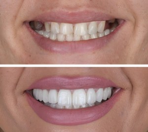 Before and after comparison of a smile makeover transforming discolored teeth with a dark tooth into a bright, uniform white smile.